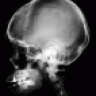 CranialFracture